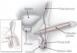Three-piece inflatable penile implant